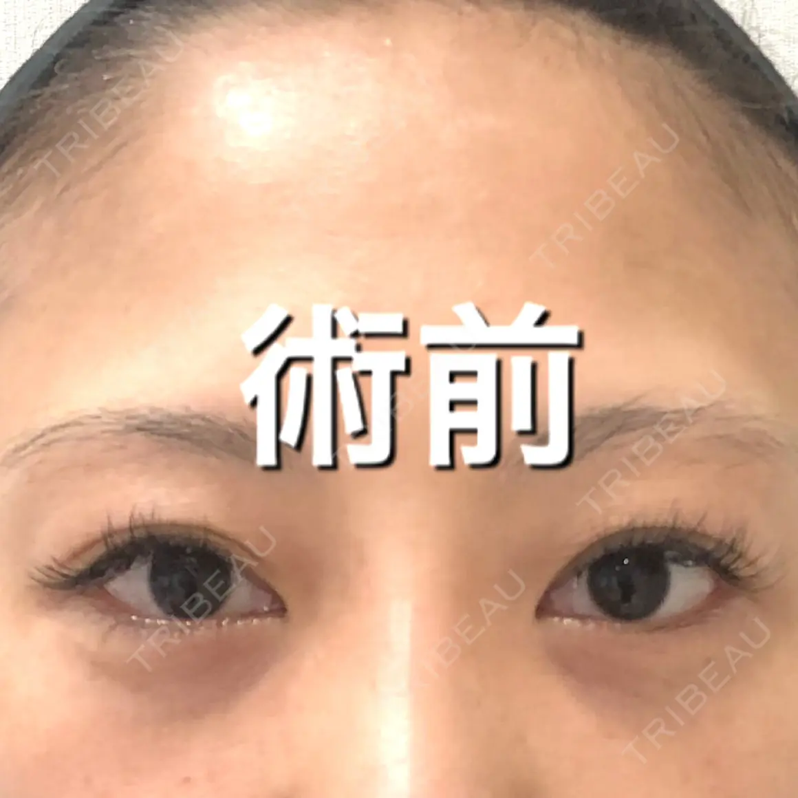 二重切開 / 上まぶたの脂肪取り BIANCA銀座 AFTER