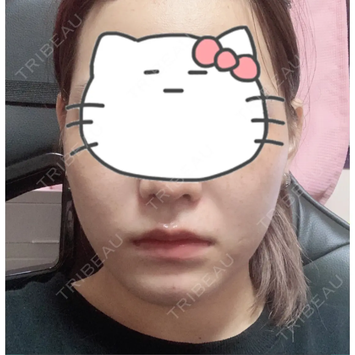 脂肪溶解注射（顔） 東京ロイヤルクリニック AFTER