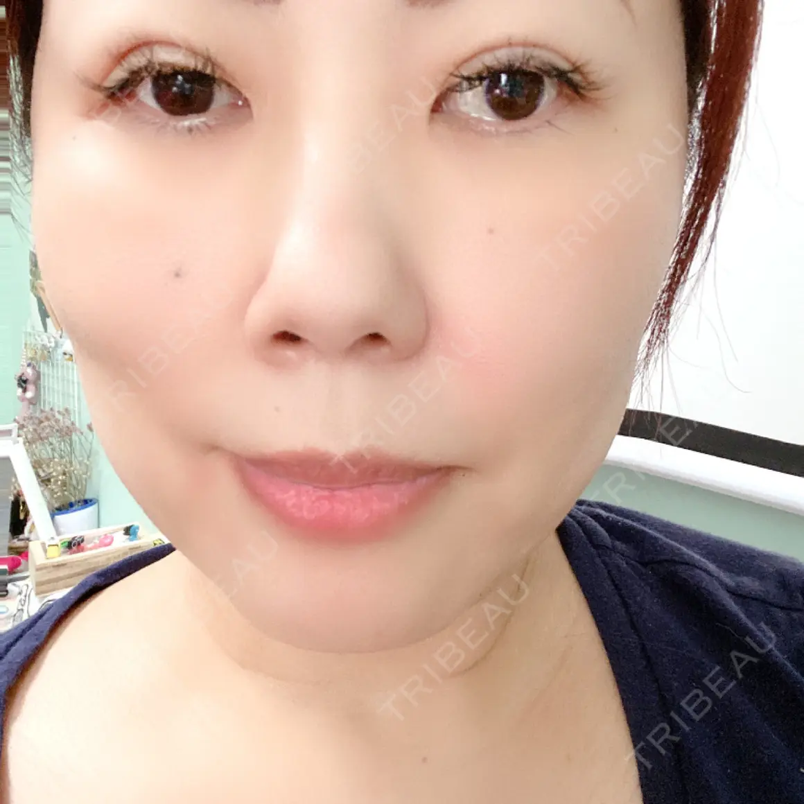 下まぶたの脂肪取り 湘南美容クリニック 千葉センシティ院 AFTER