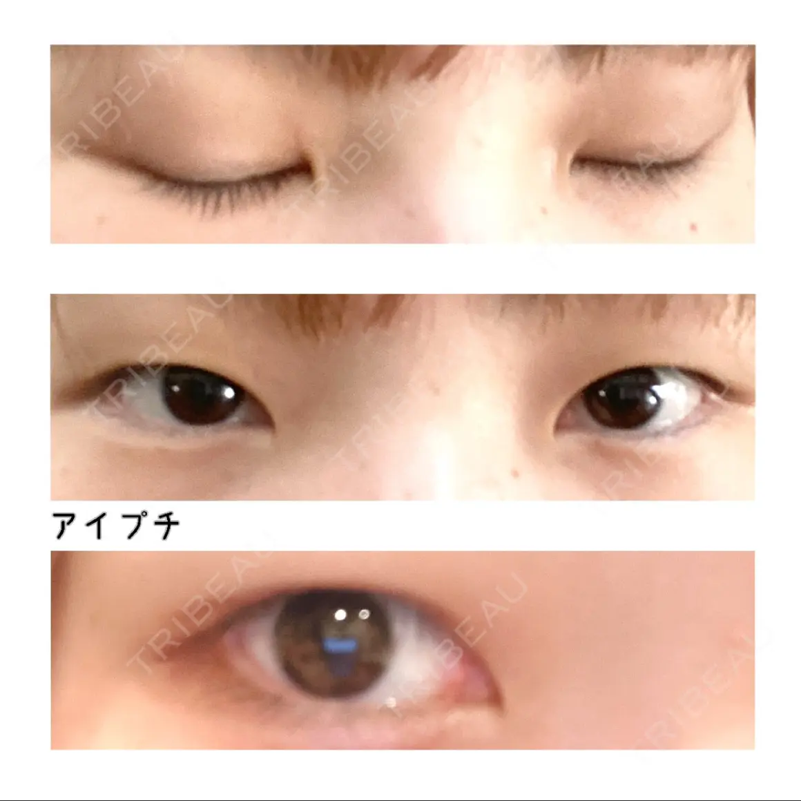 二重埋没 / 上まぶたの脂肪取り 高崎TAクリニック AFTER
