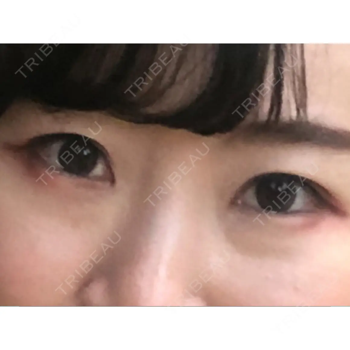 クマ治療 セオリークリニック AFTER