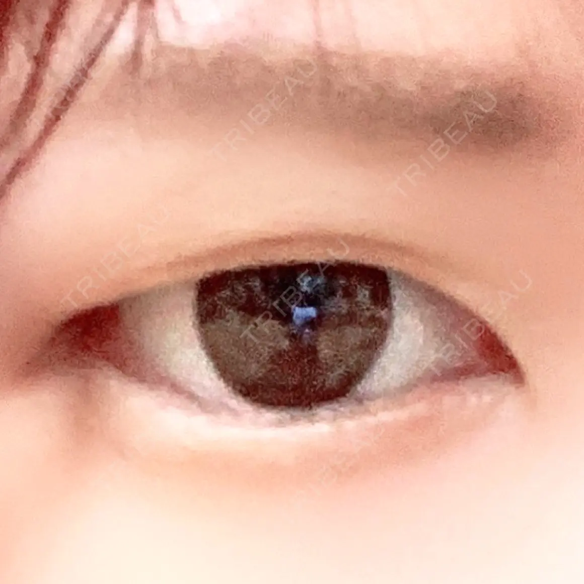 二重埋没 麹町皮ふ科・形成外科クリニック AFTER