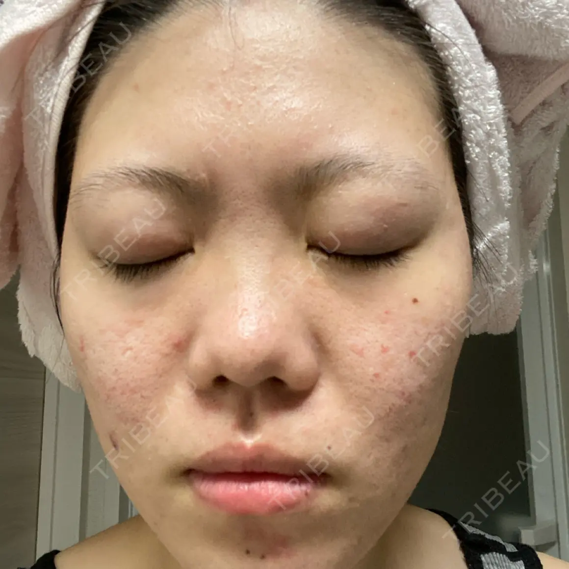 PRP皮膚再生療法 VENUS BEAUTY CLINIC　銀座院 AFTER