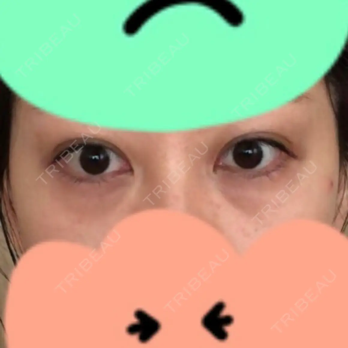 クマ治療 湘南美容クリニック 千葉センシティ院 AFTER