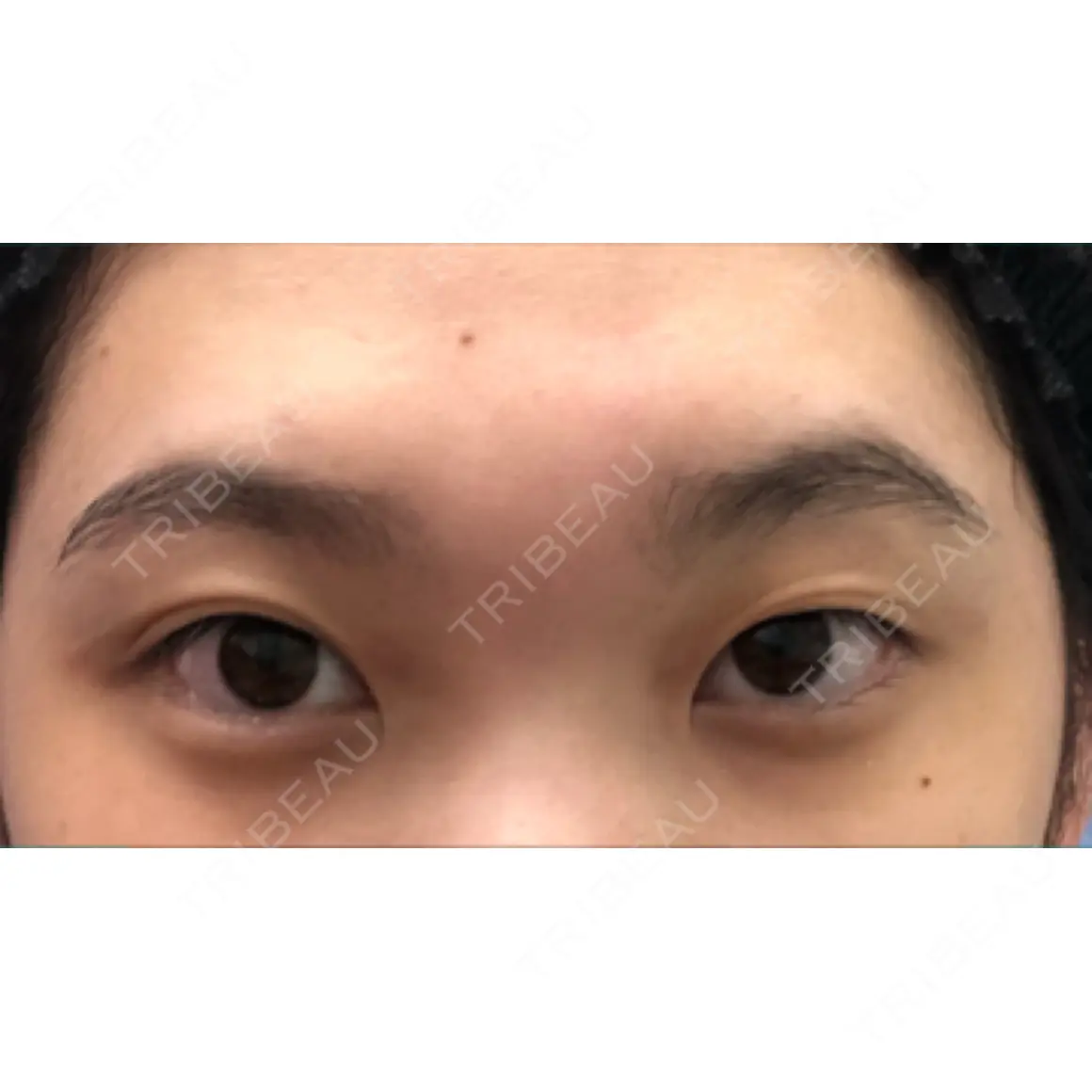二重埋没 湘南美容クリニック 西葛西院 AFTER