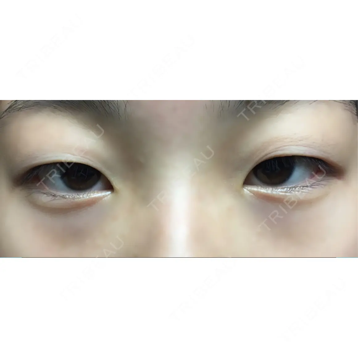二重切開 / 目頭切開 サラ美容外科 AFTER