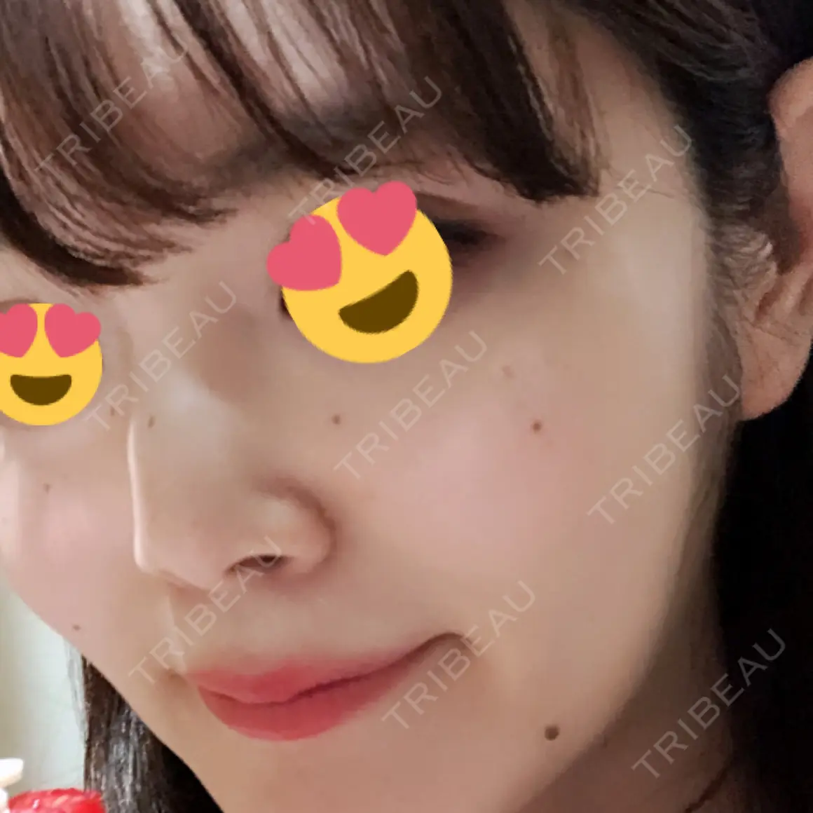 ほくろ・いぼ切除（肌） 品川美容外科 新宿院（※品川スキンクリニック提携） AFTER