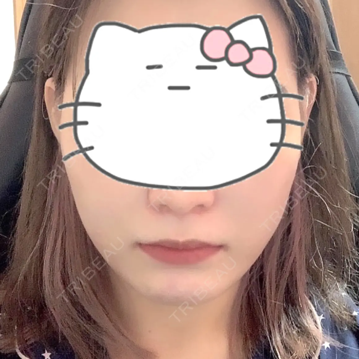 脂肪溶解注射（顔） 東京ロイヤルクリニック AFTER