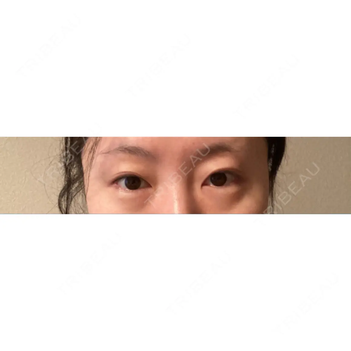 眼瞼下垂（切開） くさのたろうクリニック AFTER