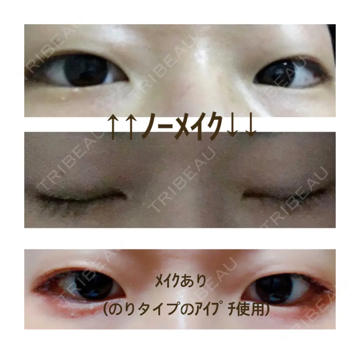 二重埋没 / 上まぶたの脂肪取り 共立美容外科 大宮院 AFTER