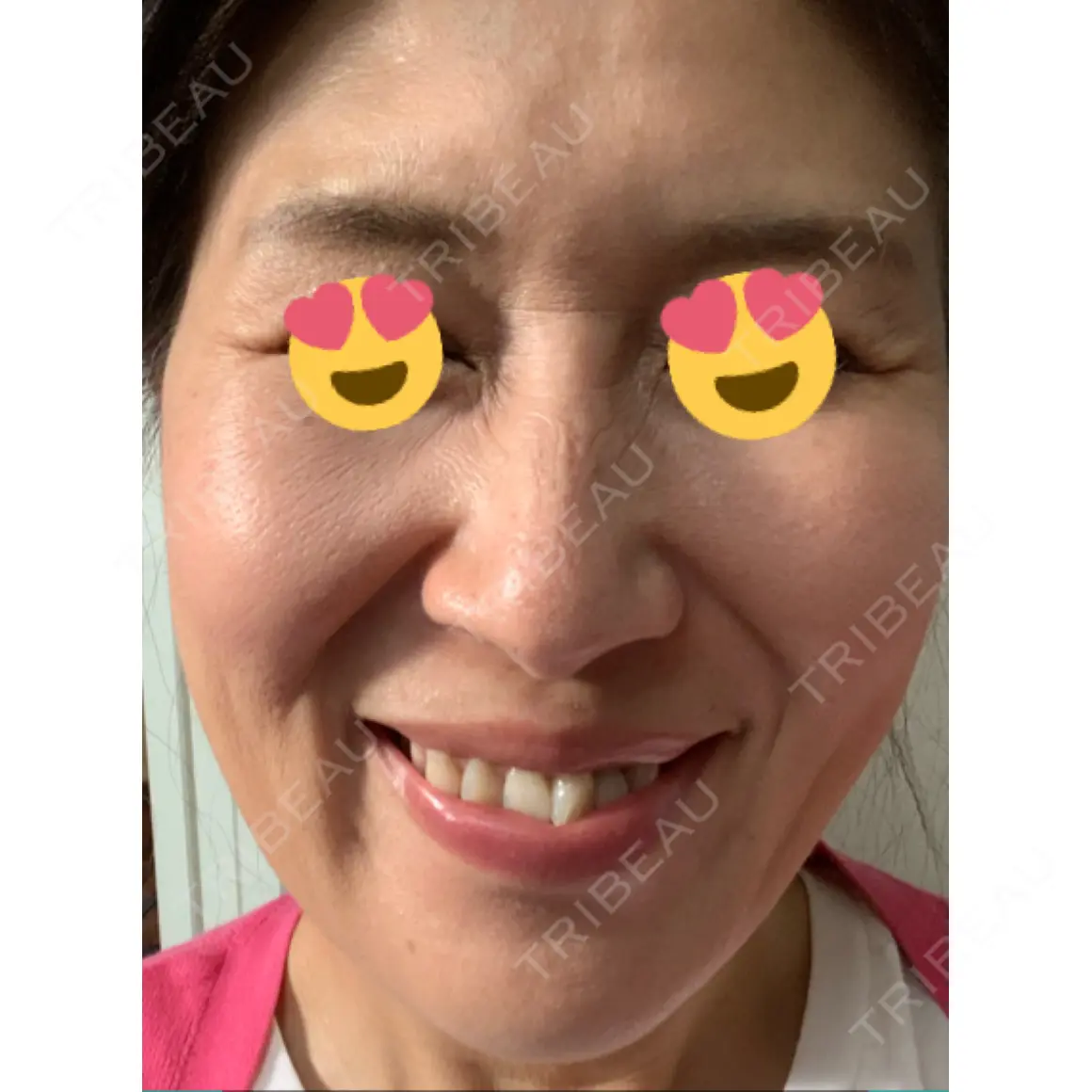 その他（肌） / 美肌レーザー / ほくろ・いぼ除去レーザー（肌） / シミ取りレーザー / フォトRF / ピコレーザートーニング（美白・肝斑） / 光治療（フォトフェイシャルなど） 川崎中央クリニック AFTER