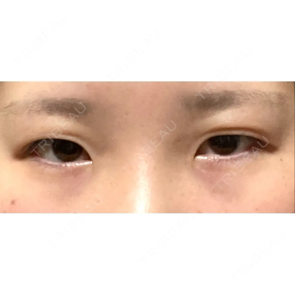 二重切開 / 目頭切開 / 上まぶたの脂肪取り プリモ麻布十番クリニック AFTER