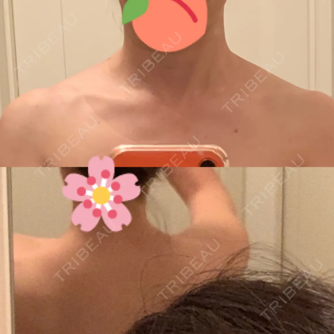 ボトックス（肩） 湘南美容クリニック 藤沢院 AFTER