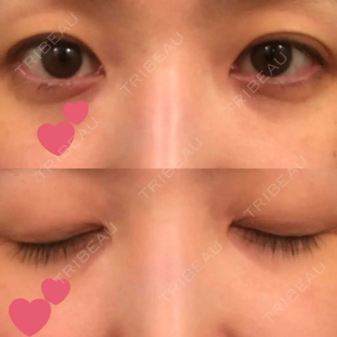 眼瞼下垂（切開） みやび形成外科 AFTER