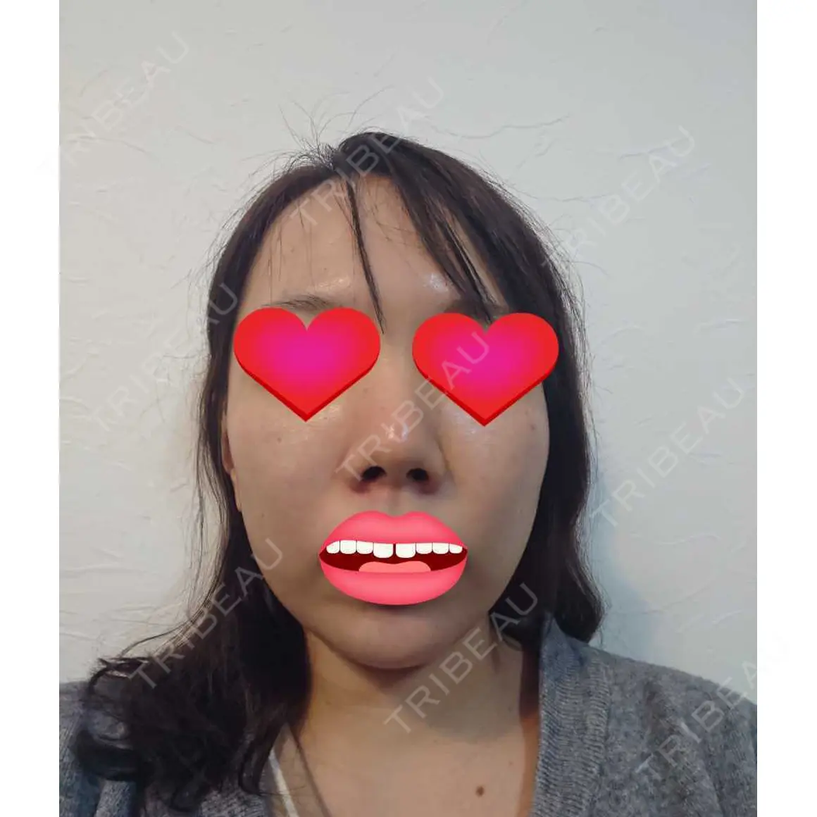 軟骨移植 フェアクリニック川口 AFTER