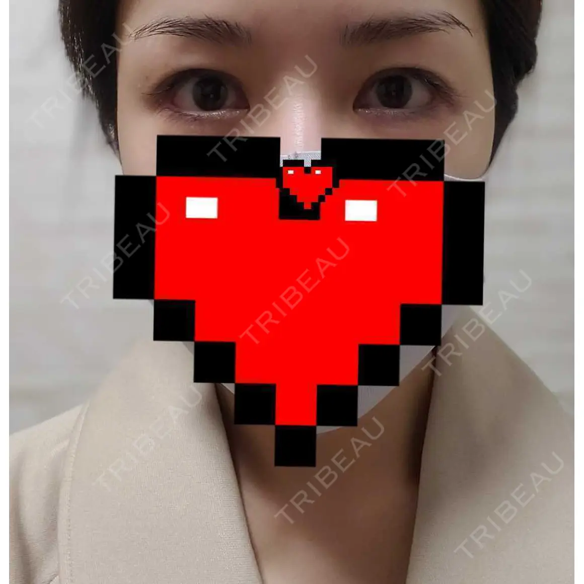 眉下切開 エイペックス美容外科 AFTER
