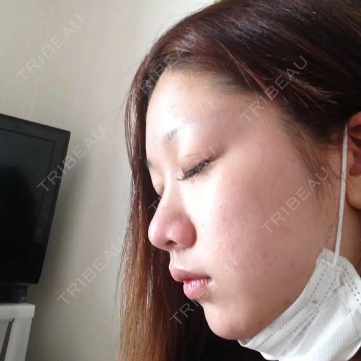 二重切開 / 目頭切開 / 眼瞼下垂（切開） / 隆鼻術 / 鼻尖形成（切開） / タレ目形成・グラマラスライン（切開） / 軟骨移植 / プロテーゼ除去 / 鼻修正 / 鼻尖縮小 / その他（鼻） グローバルビューティークリニック 大阪院 AFTER