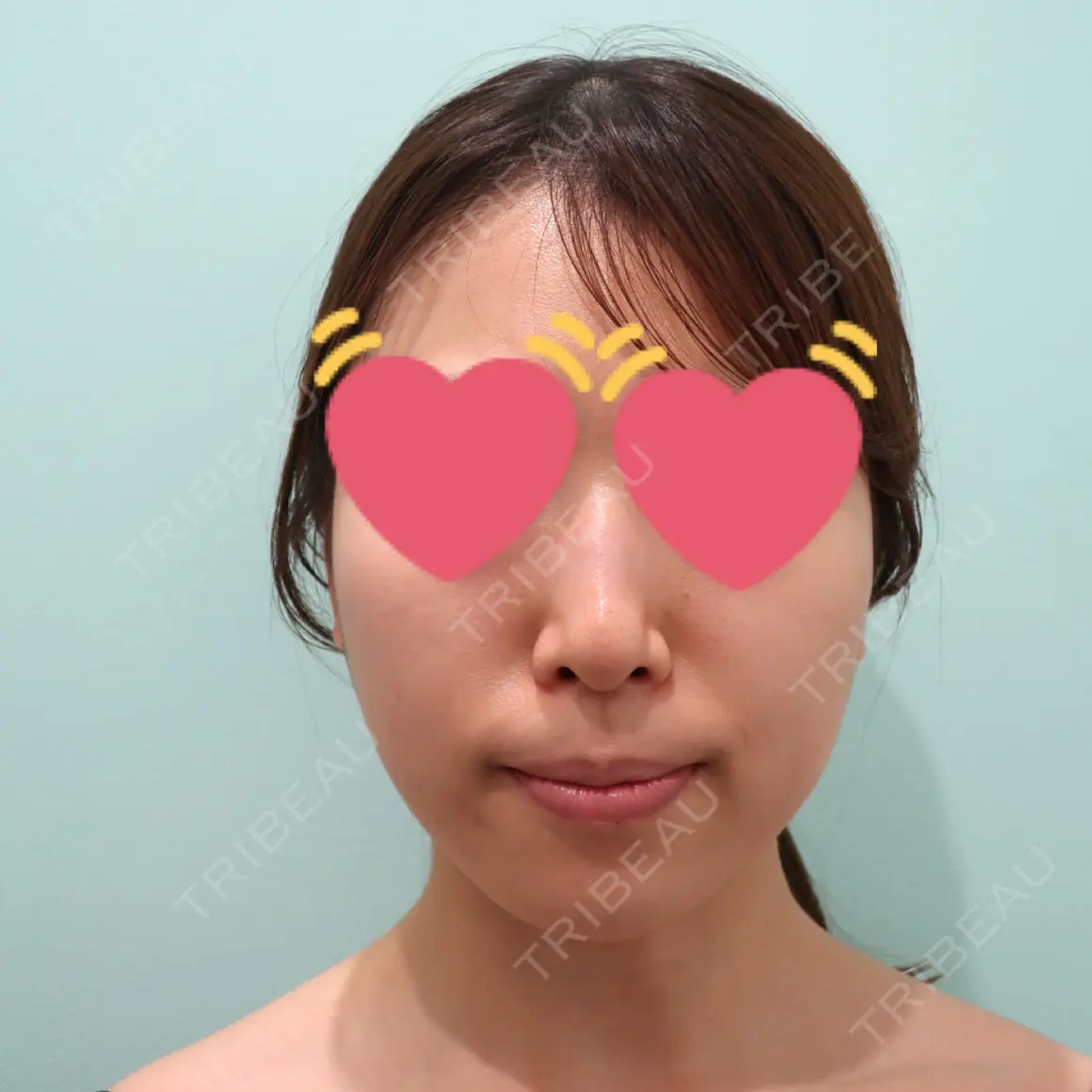 バッカルファット除去 WOM CLINIC GINZA （ワム クリニック ギンザ） AFTER
