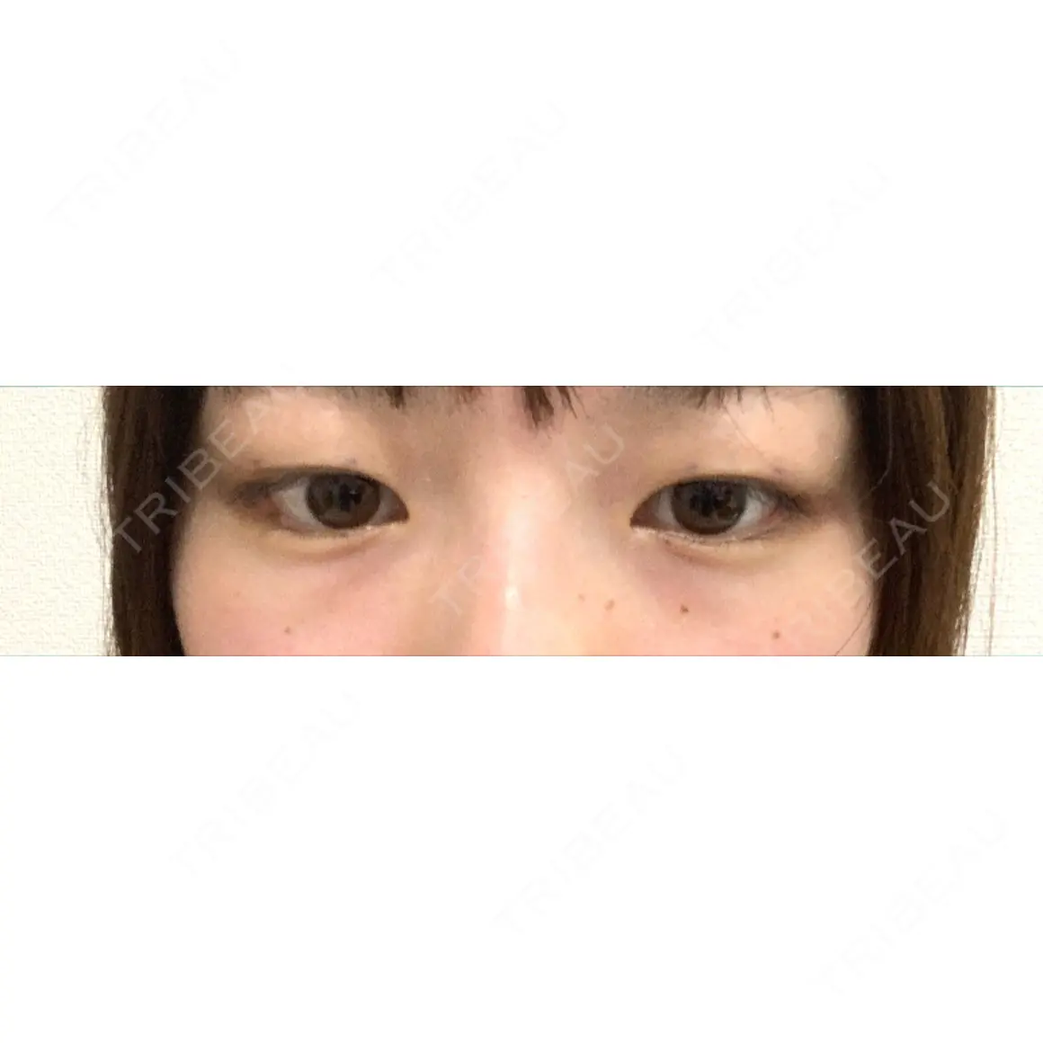 二重埋没 / 上まぶたの脂肪取り / 下まぶたの脂肪取り 東京形成美容外科 船橋院 AFTER