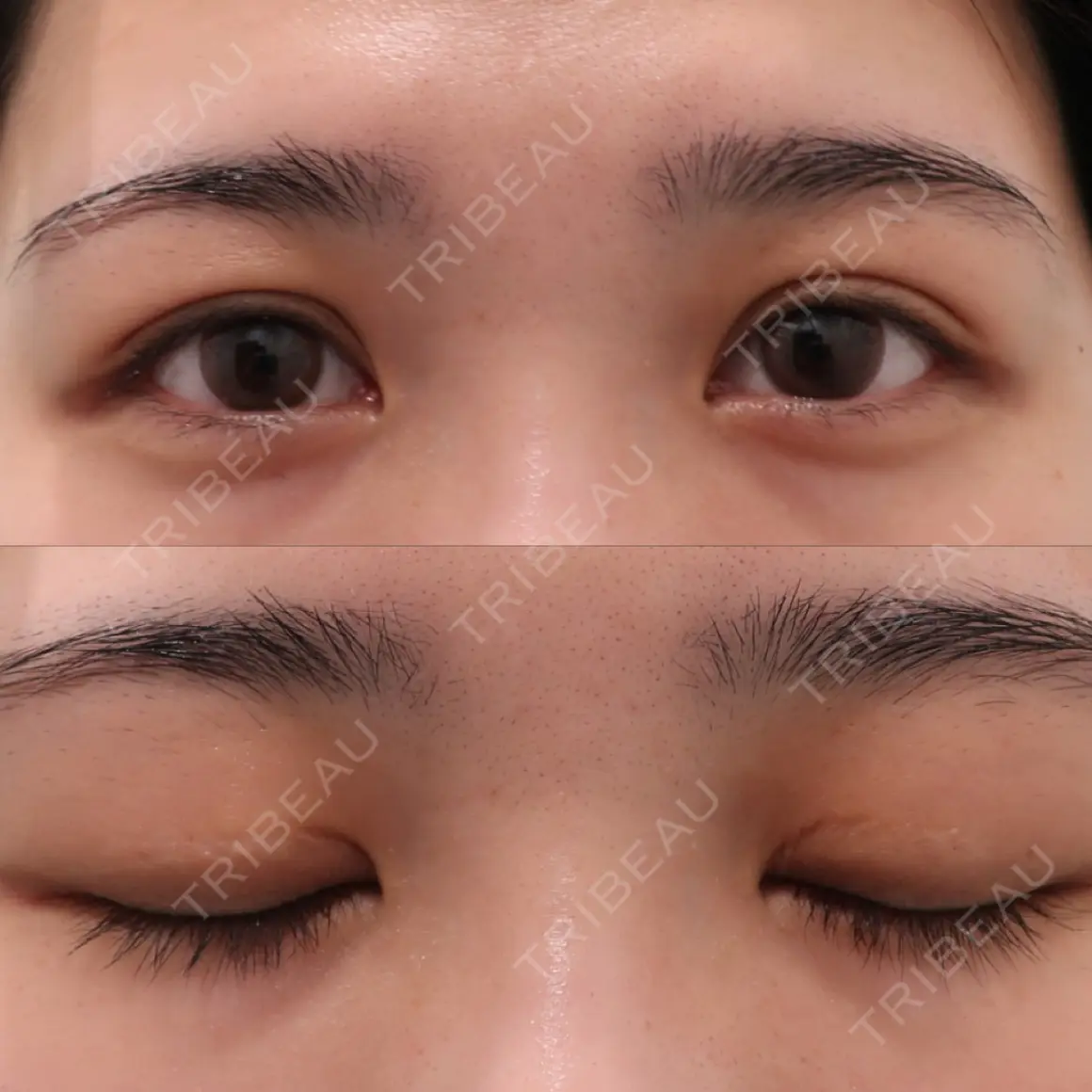 上まぶたの脂肪取り / 眉下切開 WOM CLINIC GINZA （ワム クリニック ギンザ） AFTER
