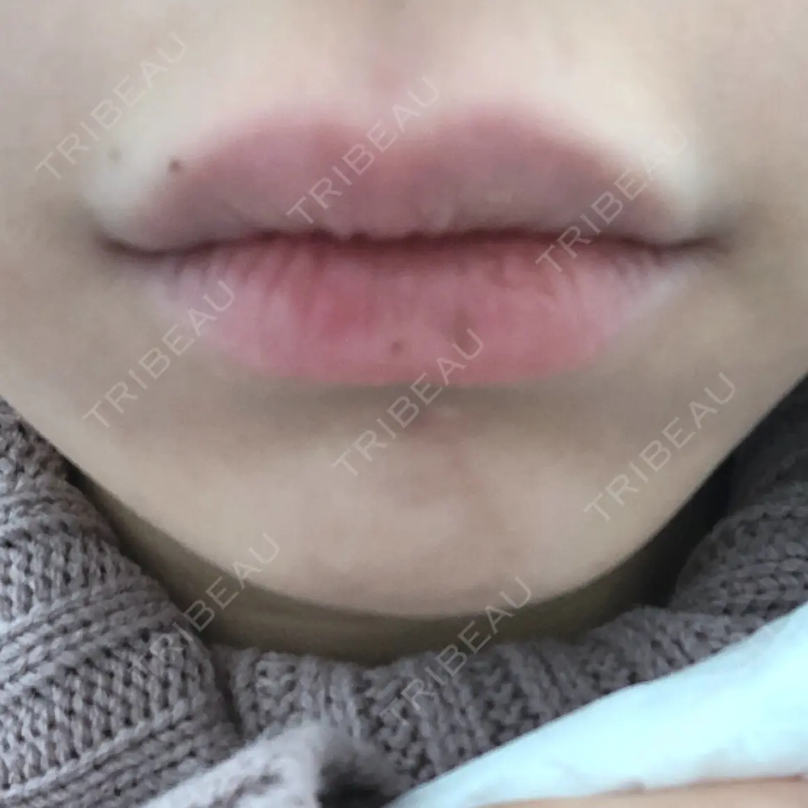 ヒアルロン酸注入（唇） 湘南美容クリニック 小倉院 AFTER
