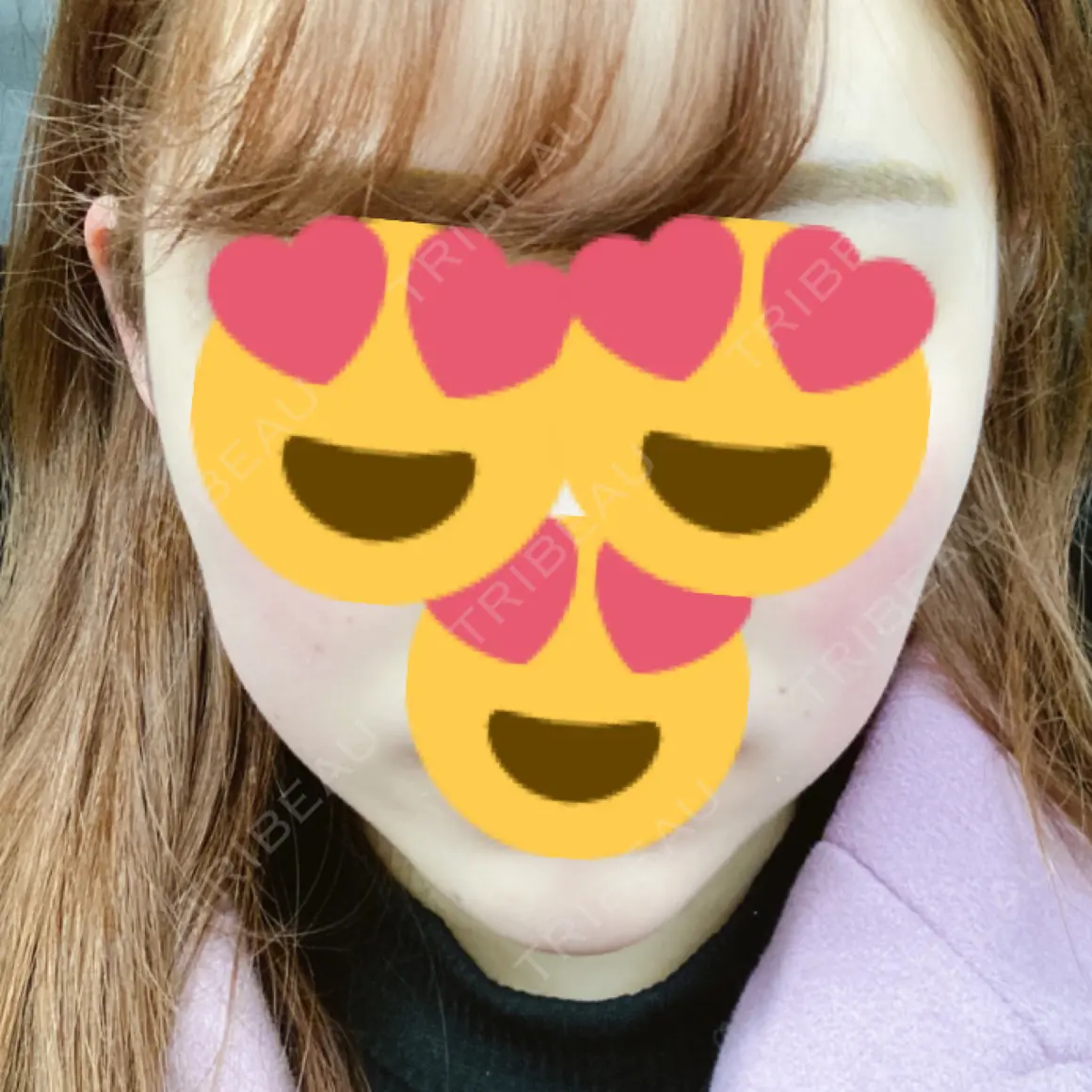 ハイフ（顔） 湘南美容クリニック 新宿本院 AFTER
