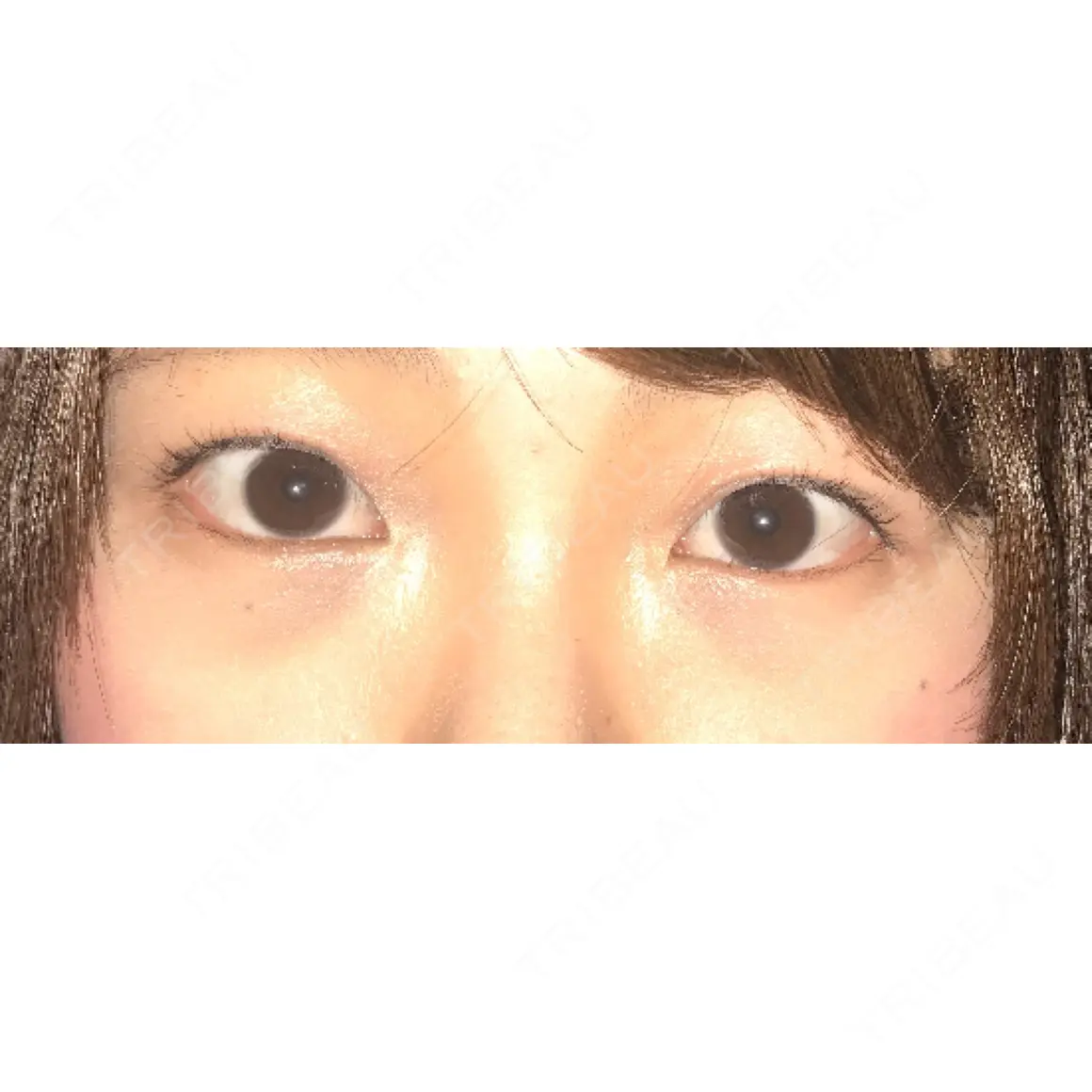 二重埋没 / 目頭切開 / ヒアルロン酸注入（涙袋） 湘南美容クリニック 橋本院 AFTER