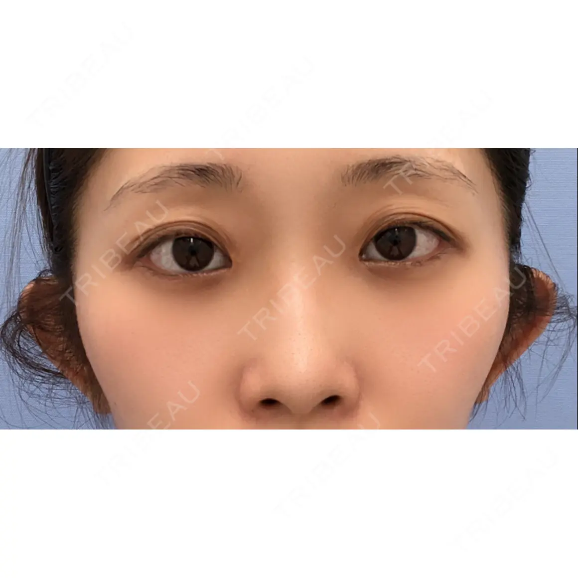 二重切開 / 目頭切開 / 眼瞼下垂（切開） / 上まぶたたるみ取り 湘南美容クリニック 高田馬場院 AFTER