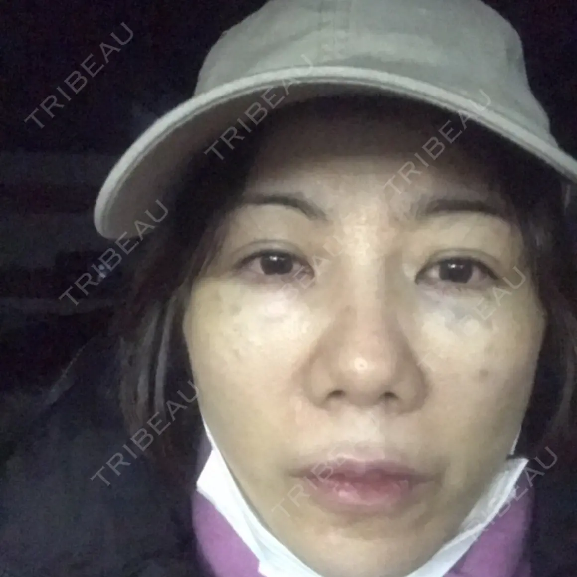 クマ治療 / 前額リフト 湘南美容クリニック 千葉センシティ院 AFTER