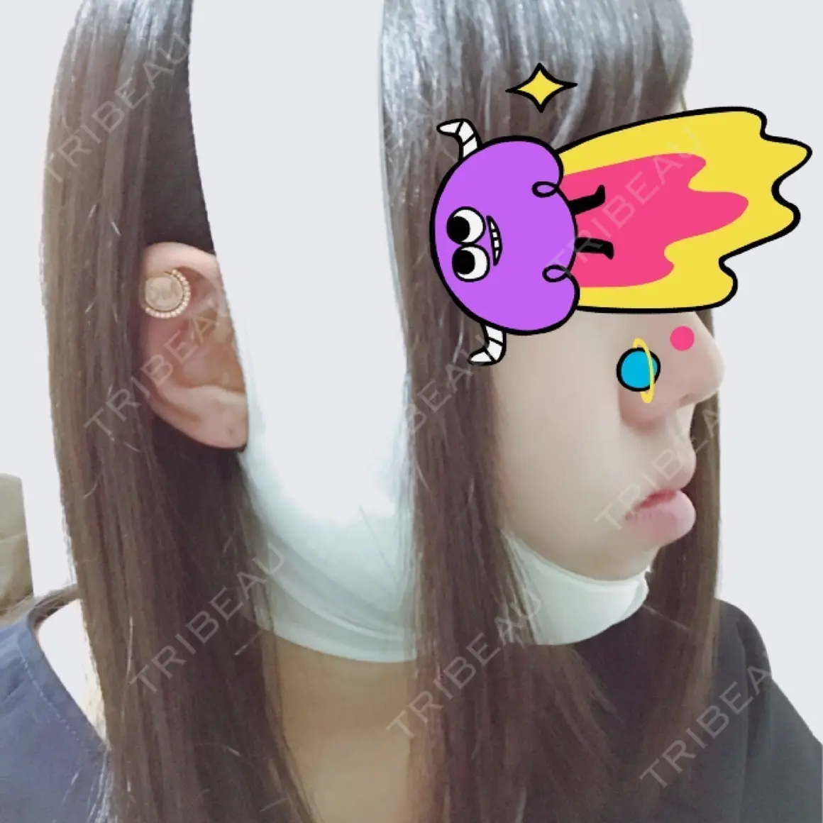 脂肪吸引（顔） 湘南美容クリニック 大阪あべの院 AFTER