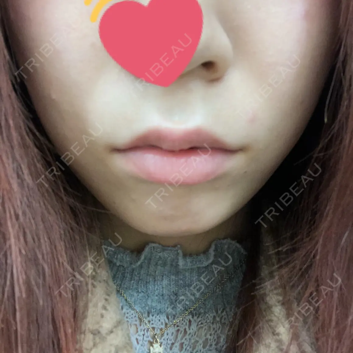 ヒアルロン酸注入（唇） / ボトックス（口角） アクトリー勝どきウェルネスメディカルクリニック AFTER