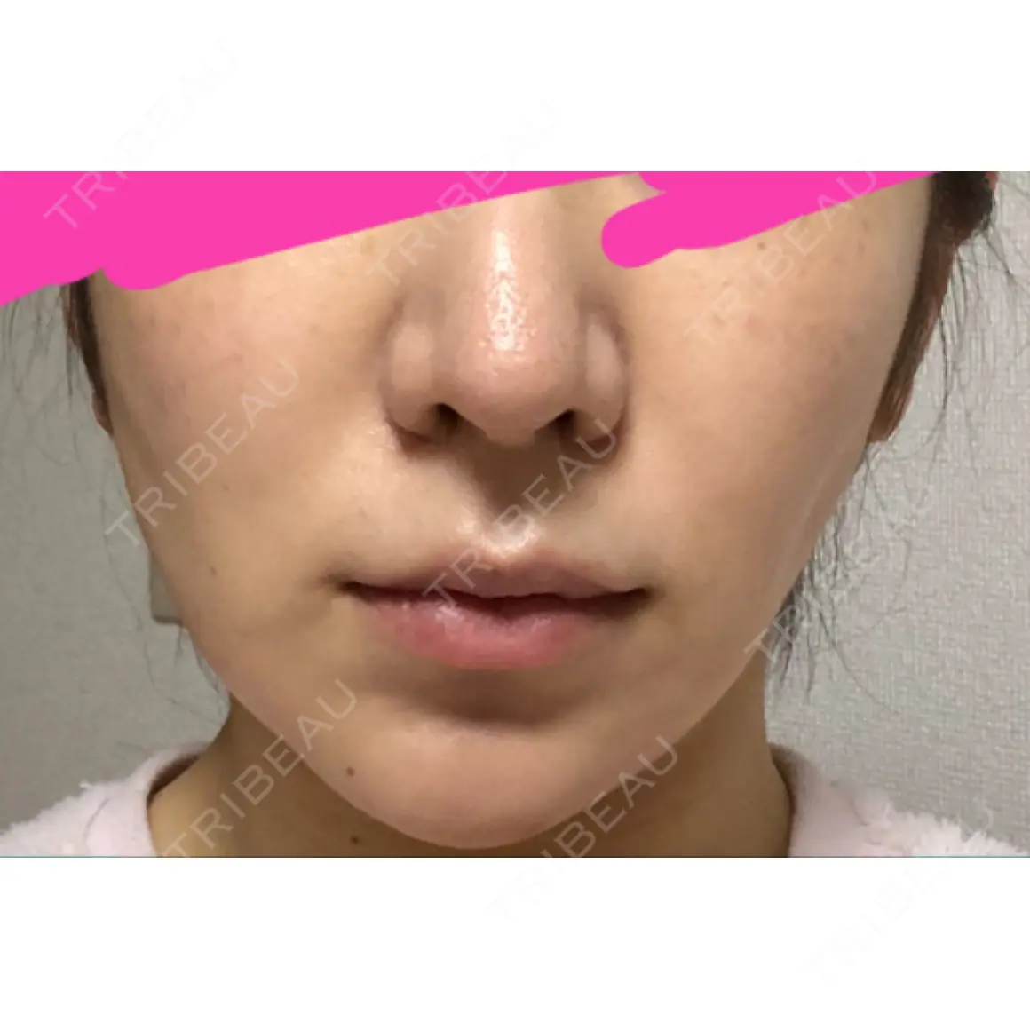 糸リフト ノーチェビューティクリニック AFTER