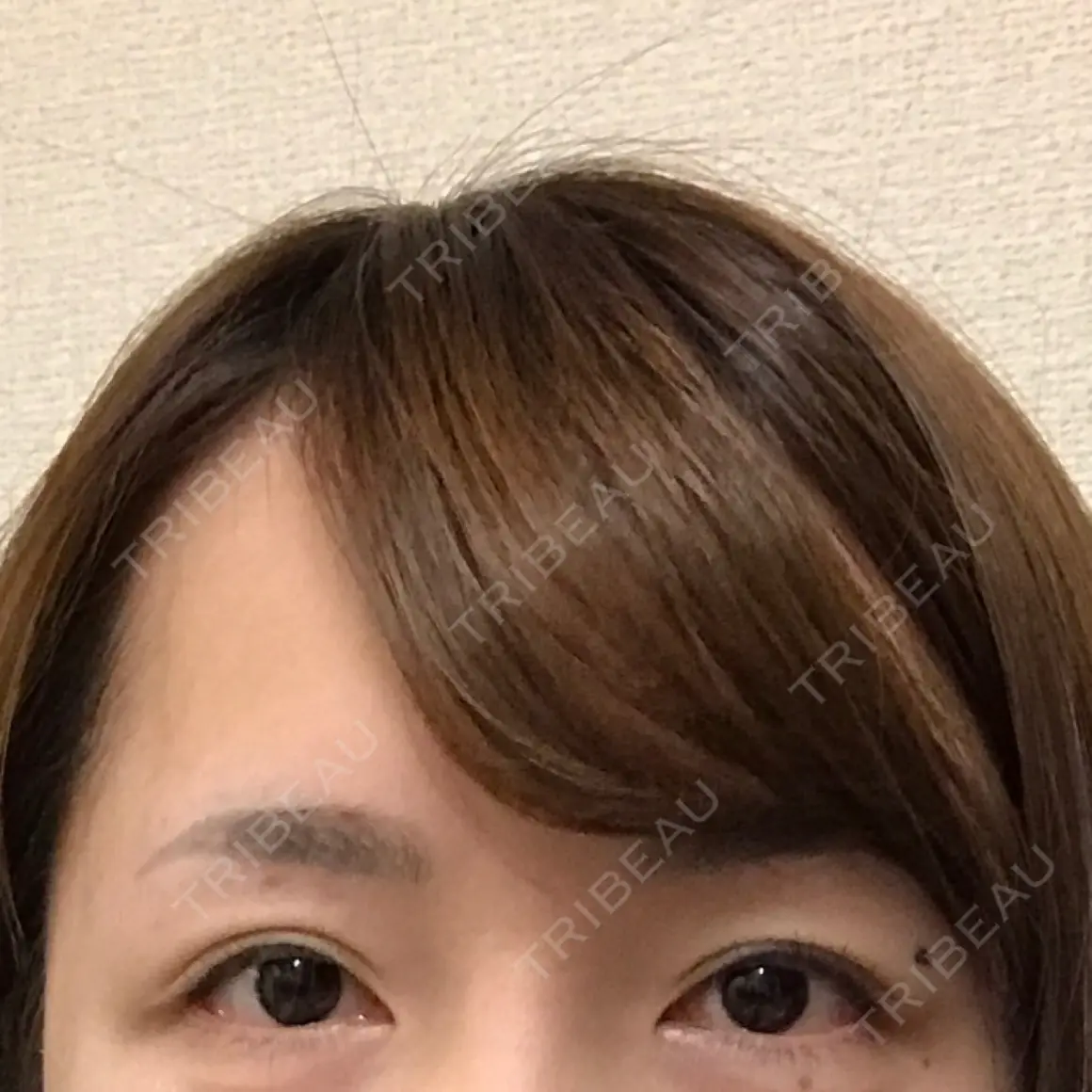 二重切開 高須クリニック 名古屋院 AFTER