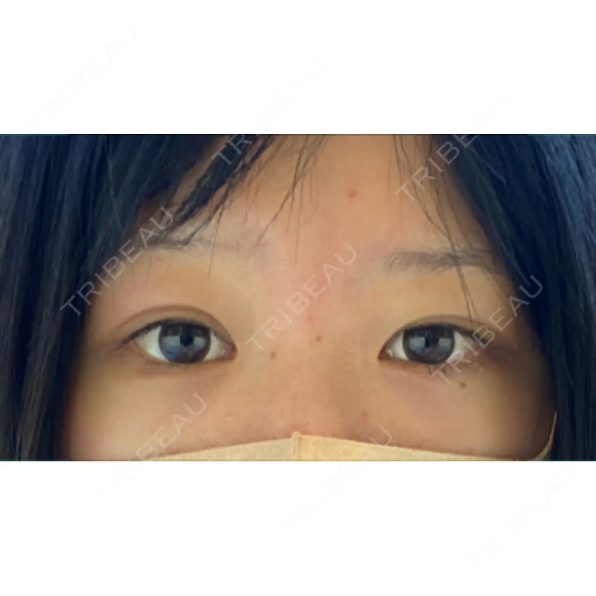 二重埋没 / 目頭切開 / 目尻切開 / タレ目形成・グラマラスライン（切開） HAAB×DREAM BEAUTY CLINIC 東京本院 AFTER