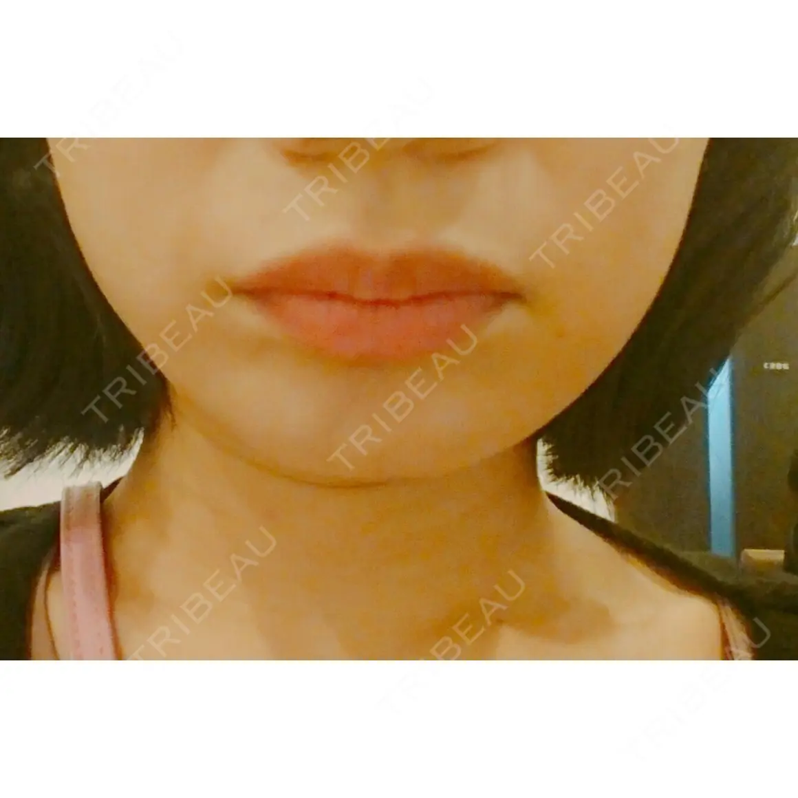 ボトックス（エラ・小顔） 湘南美容クリニック 新宿南口院 AFTER