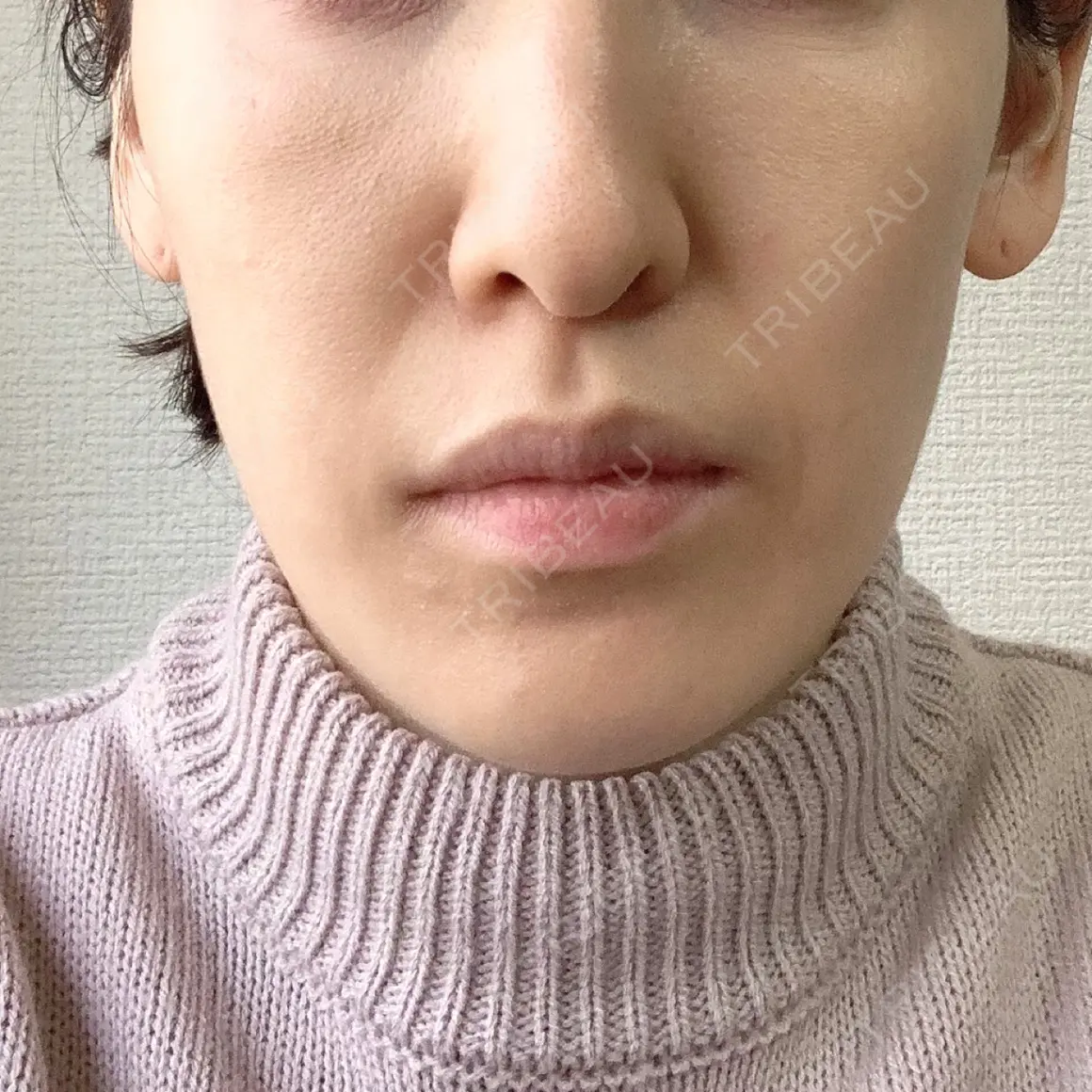 ハイフ（顔） 東京美容皮膚科CLINIC AFTER