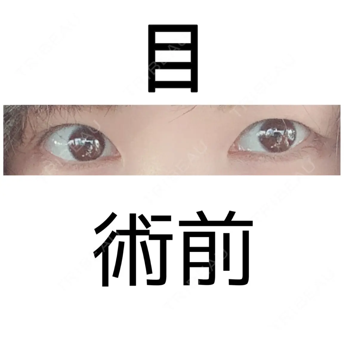 二重切開 eクリニック 金沢本院 AFTER