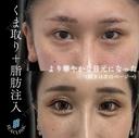目の下のクマ取り before画像 サムネイル用