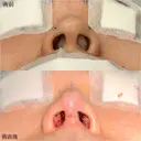 鼻尖形成3D法＋軟骨移植 0日後 サムネイル用