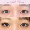 ルラループ二重術・目尻切開・タレ目形成・下逆さまつ毛修正 before画像 サムネイル用