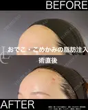 脂肪注入＋ナノファット全顔入れ放題（額＋こめかみの部分の症例） before画像 サムネイル用