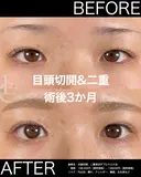 人気♥目頭切開＋切らない二重 90日後 サムネイル用