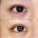 加賀デザイン×タレ目尻切開 after画像 サムネイル用