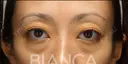 目の下クマたるみ取り before画像 サムネイル用