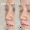 加賀ヒアル×鼻ヒアルロン酸 after画像 サムネイル用