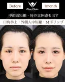 口角挙上・外側人中短縮・M字リップ 30日後 サムネイル用