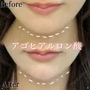 顎　ヒアルロン酸 before画像 サムネイル用