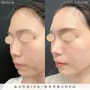 MD式鼻尖形成3D法+軟骨移植 before画像 サムネイル用