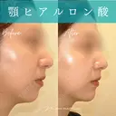 ヒアルロン酸注入（あご） after画像 サムネイル用