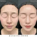 鼻尖形成3D法＋軟骨移植 180日後 サムネイル用